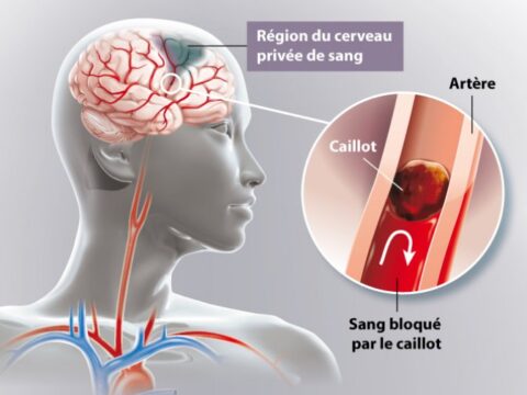 AVC (accident vasculaire cérébral) : les signes et que faire ?